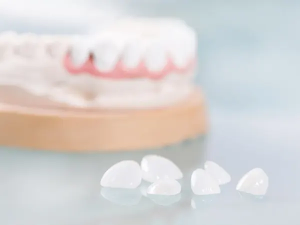 Carillas dentales - Clínica dental en Madrid Ivoria carillas dientes madrid