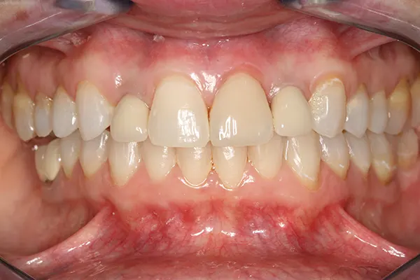 Carillas dentales - Clínica dental en Madrid Ivoria carilla-dental-antes