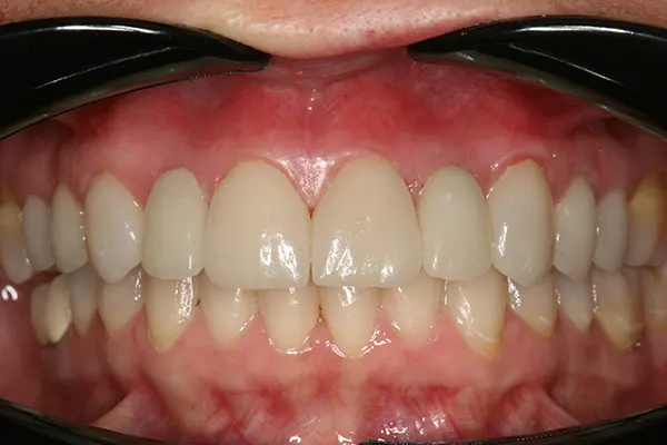 Carillas dentales - Clínica dental en Madrid Ivoria carilla-dental-despues
