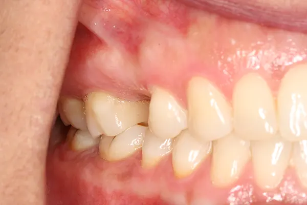 Coronas y puentes dentales - Clínica dental en Madrid Ivoria corona-dental-antes