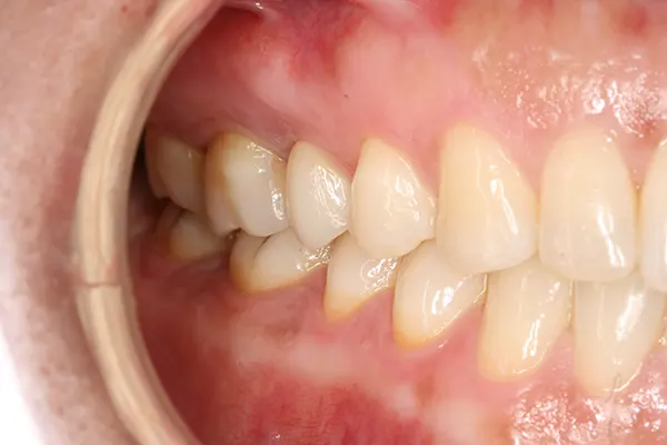 Coronas y puentes dentales - Clínica dental en Madrid Ivoria corona-dental-despues