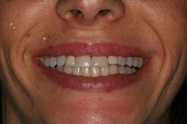 Diseño Digital de la Sonrisa - Clínica dental en Madrid Ivoria diseño-sonrisa-antes