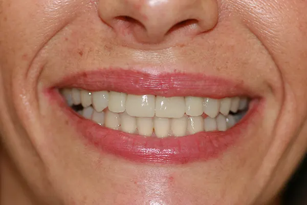 Diseño Digital de la Sonrisa - Clínica dental en Madrid Ivoria diseño-sonrisa-despues