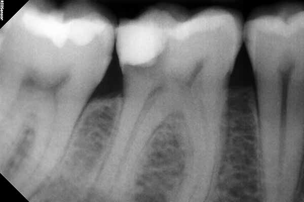 Odontología conservadora - Clínica dental en Madrid Ivoria endodoncia-antes