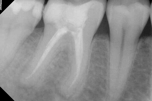 Odontología conservadora - Clínica dental en Madrid Ivoria endodoncia-despues