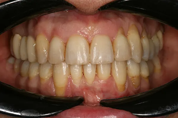 ortodoncia-caso-despues