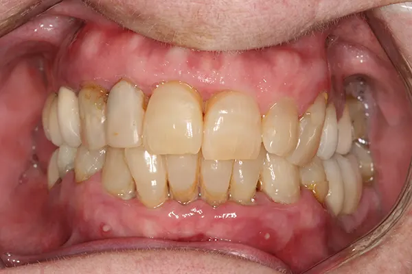 protesis-dental-antes