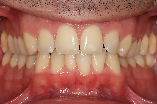 Invisalign antes dientes separados