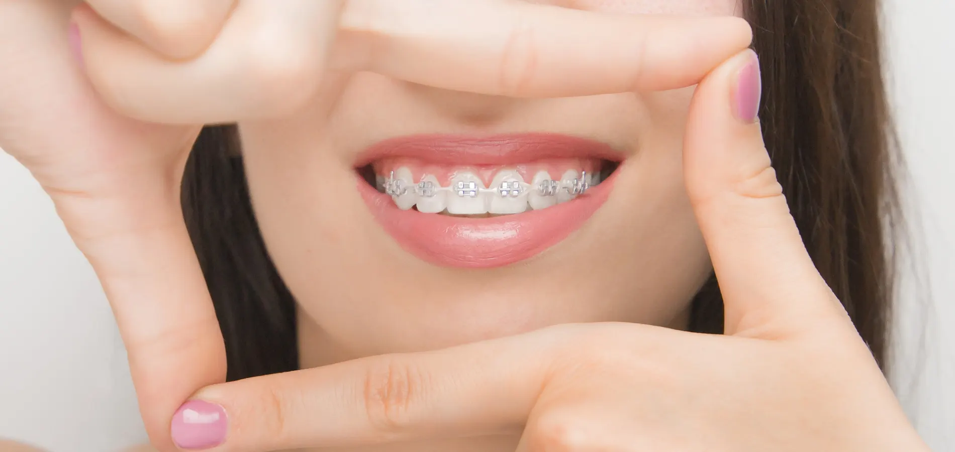 Precio del Invisalign y de los brackets Clínica Ivoria