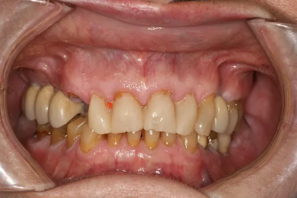 Desgaste en los dientes - Clínica dental en Madrid Ivoria desgaste en los dientes antes