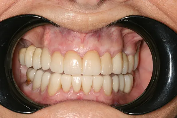 Desgaste en los dientes - Clínica dental en Madrid Ivoria desgaste en los dientes después